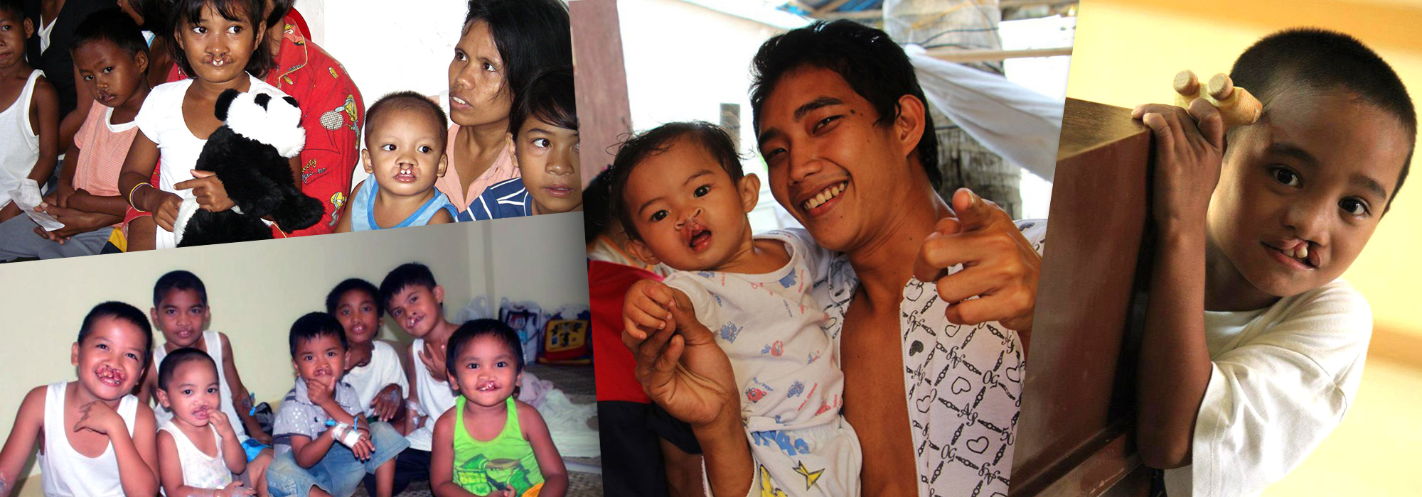 8,000 children are born in the Philippines each year with a facial deformity