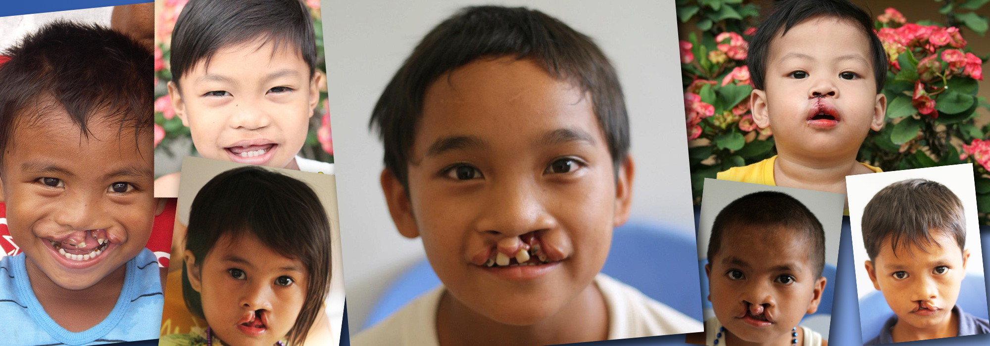 Children with facial deformities in the Philippines overwhelmingly live in rural areas with little access to health care